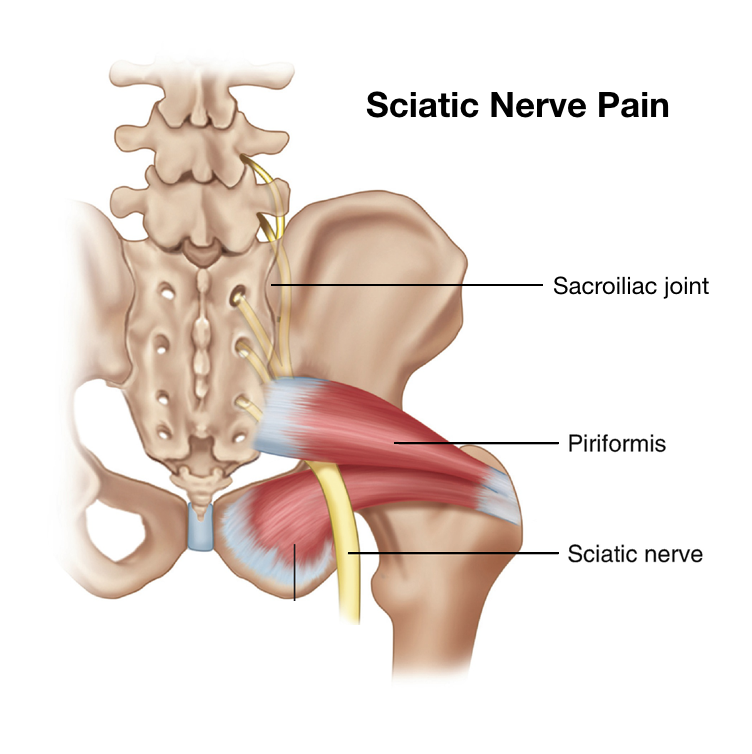 Sciatica vs. Sciatic Nerve Pain