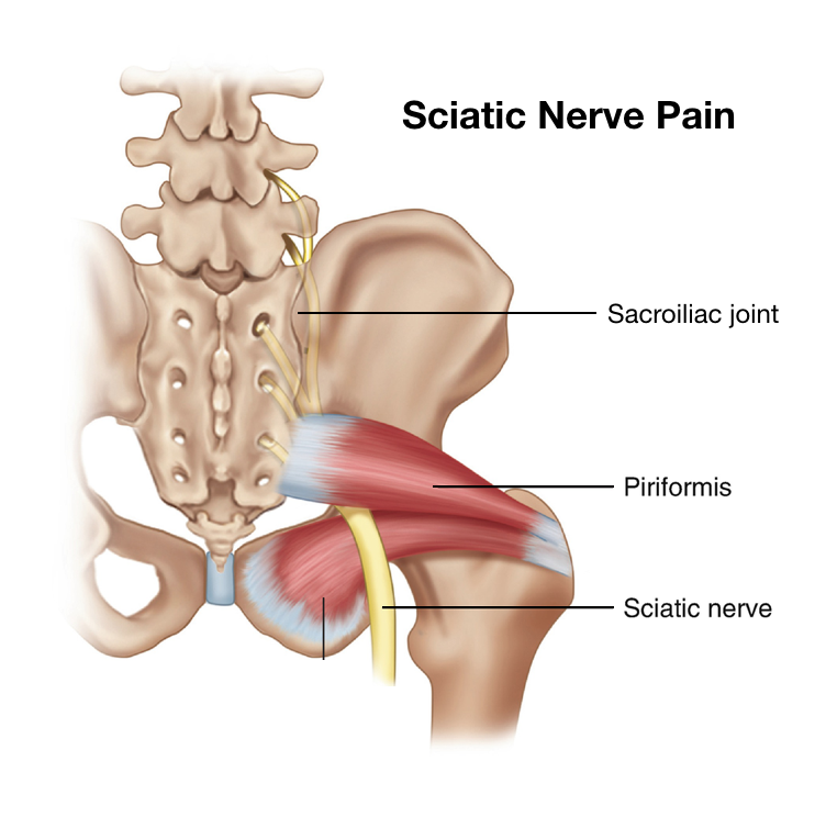 Sciatica Vs Sciatic Nerve Pain Sugar Land Health Center